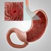 Gastritis, atau erosi lambung: gejala utama, pengobatan, diet