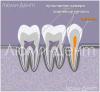 Bagaimana menemukan dan merawat saluran gigi di Lumident