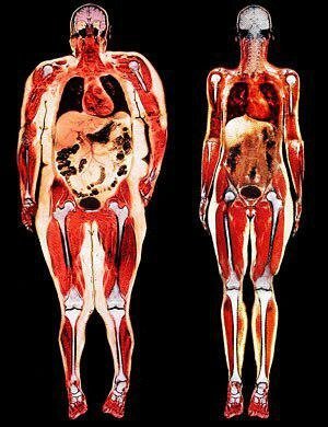 Kiri - hanya visceral obesitas. Semua organ menahan dengan lemak.