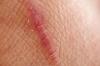 Bekas luka pada kulit: apa itu dan bagaimana untuk menghapusnya