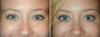 Apa kombinasi prosedur kosmetik akan bombichesky berlaku untuk wajah Anda