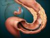 Sindrom Payra, mengganggu operasi normal dari usus