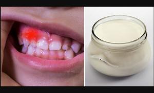 Bagaimana mencegah kerusakan gigi dan memperkuat sistem kekebalan tubuh