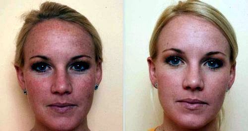 Karbon mengupas. Foto Sebelum dan Sesudah. Pasien memiliki jenis kulit berminyak.