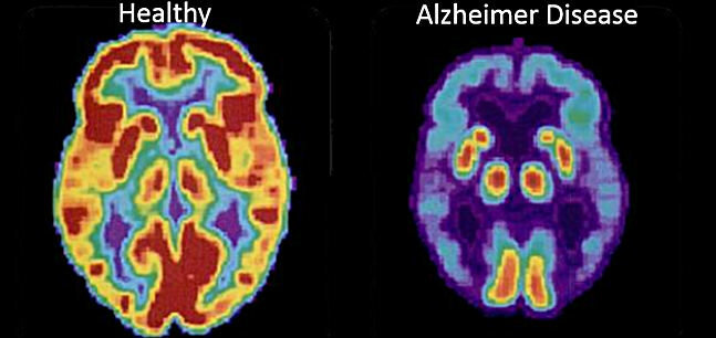 Pertama gambar - otak dari orang yang sehat, yang kedua - penyakit Alzheimer 