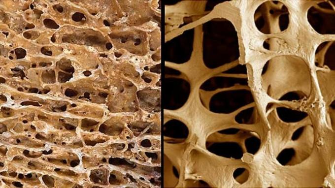 osteoporosis