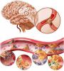 Cerebral aterosklerosis: bagaimana memperlakukan, apa gejalanya?