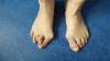 Gout: tanda-tanda pertama dari penyakit