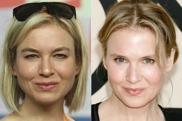 Aktris Zellweger sebelum dan sesudah blepharoplasty atas
