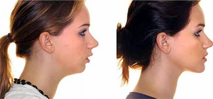 Itu mengubah kontur wajah setelah koreksi dari oklusi distal. Harap dicatat bahwa gadis itu menghilang dagu kedua
