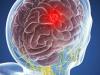 Tumor otak: 5 gejala yang tidak dapat diabaikan