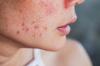 Cara merapikan kulit Anda setelah musim panas: perawatan di rumah dan di salon