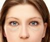 Bagaimana menyingkirkan tanpa operasi, hernia dan kelopak mata bawah kantung mata
