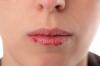 5 tips tentang cara untuk mencegah chapping bibir